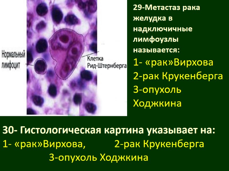 29-Метастаз рака желудка в надключичные лимфоузлы называется: 1- «рак»Вирхова 2-рак Крукенберга 3-опухоль Ходжкина 
